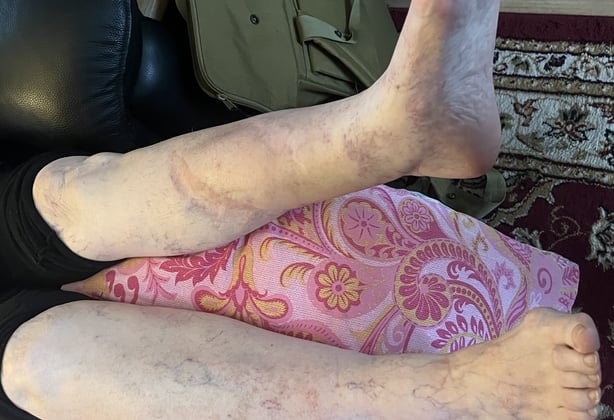 Woman with dog attack injuries