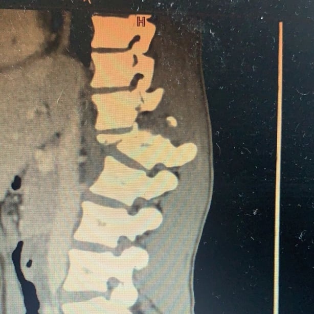 X-Ray of Rory Motherway's spine
